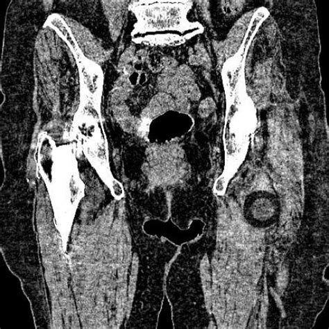 hip arthroplasty icd 10|infected hip arthroplasty icd 10.